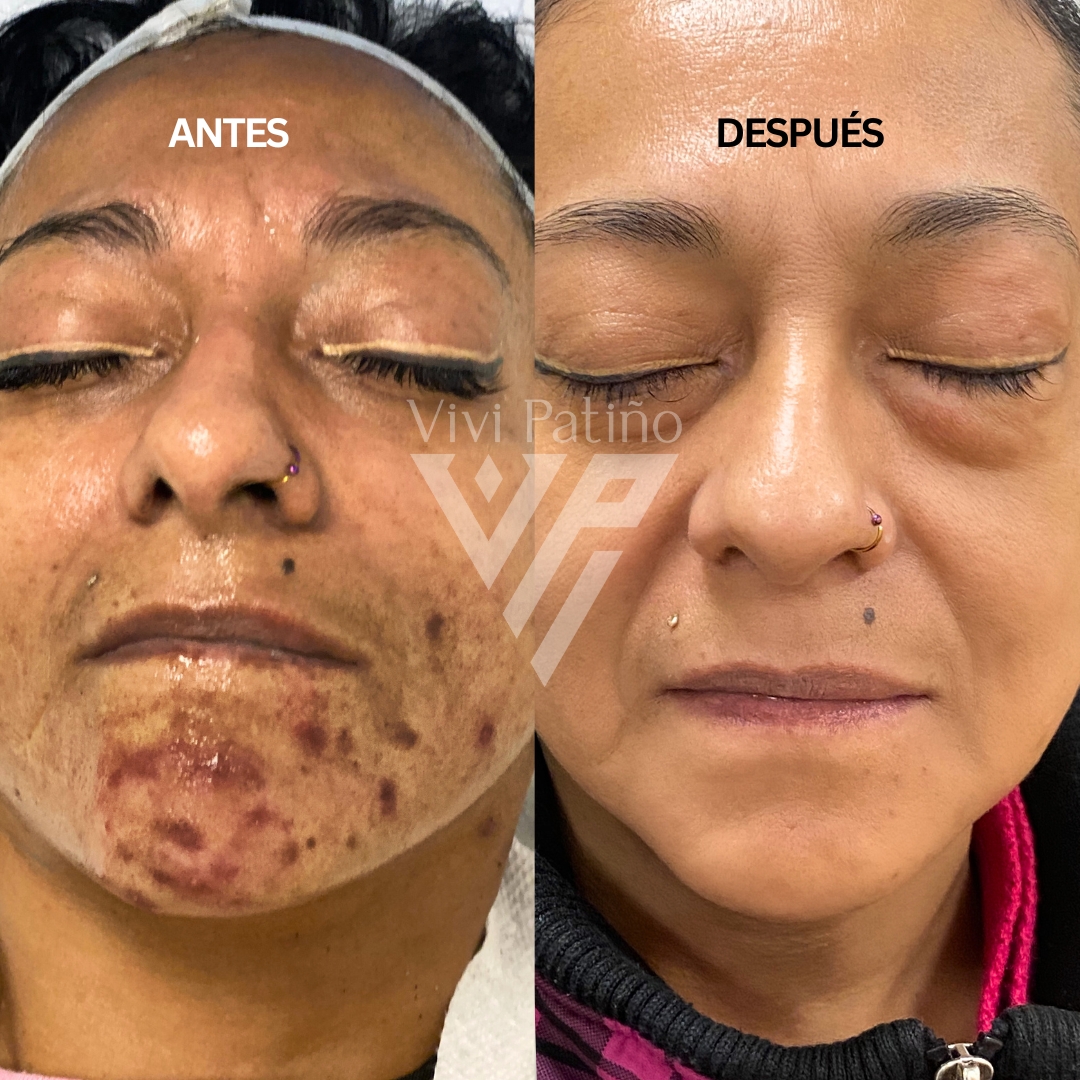 ACNE FACIAL