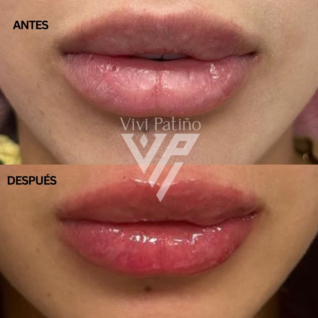 INJECTABLES