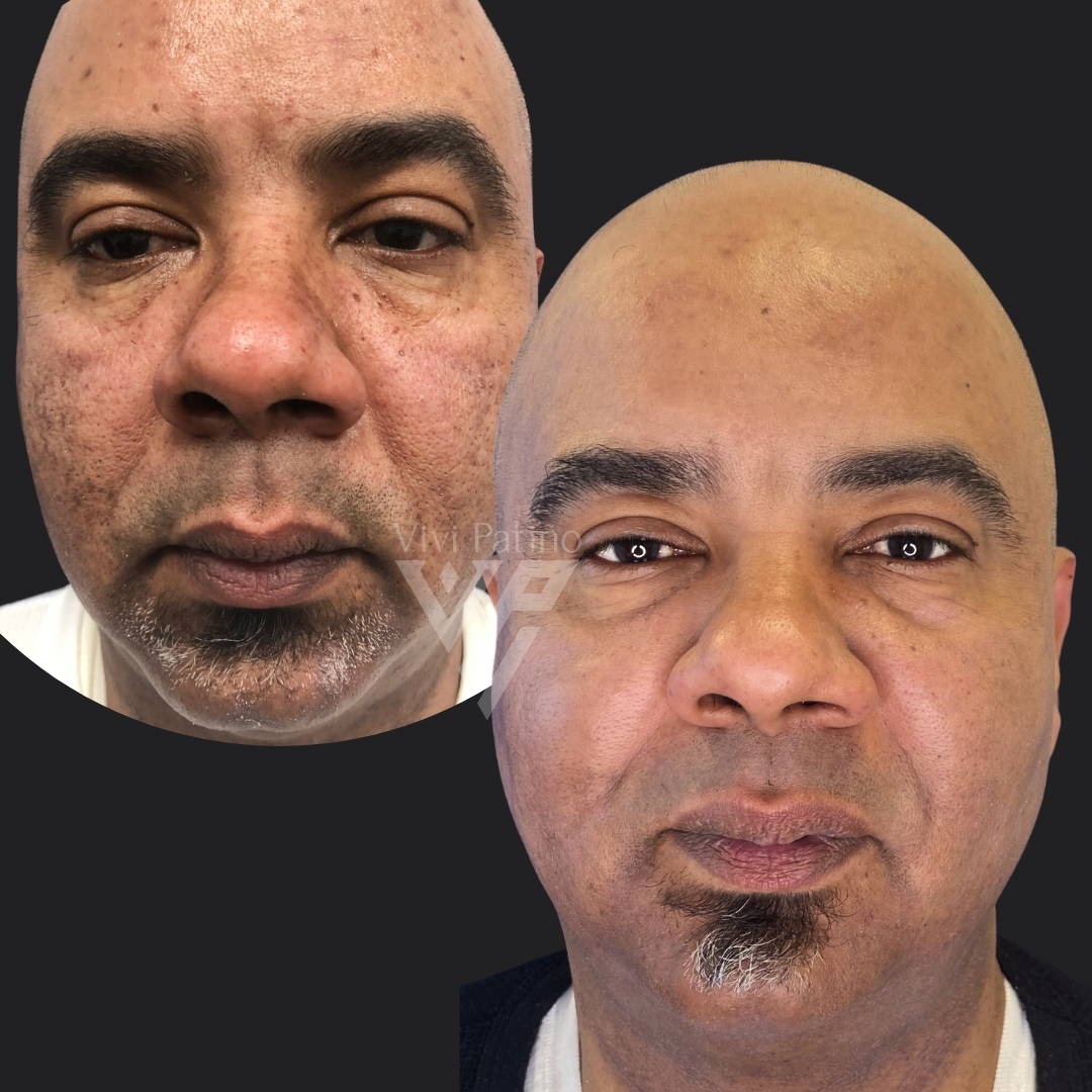 FACIAL REJUVENATION