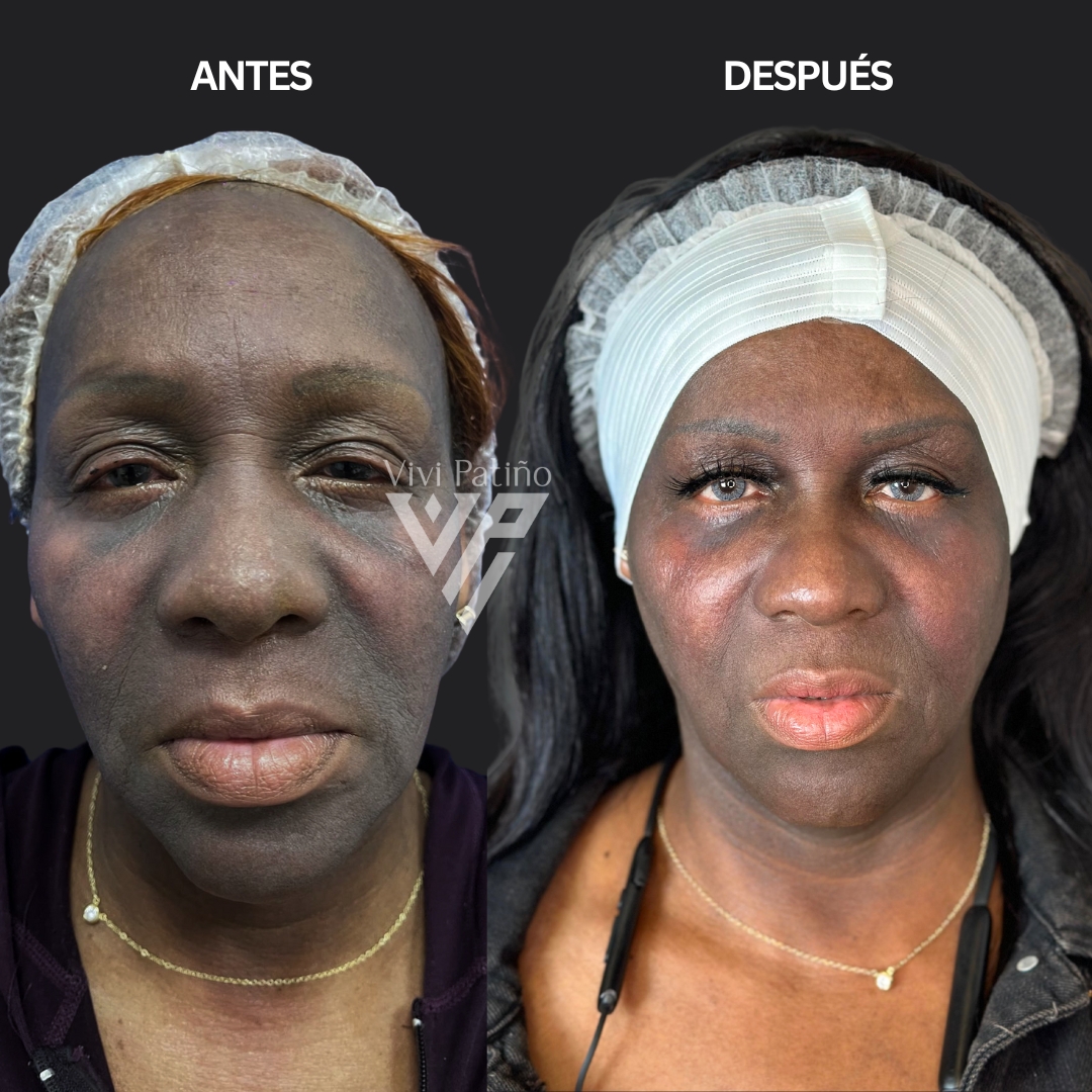 MELASMA TREATMENT